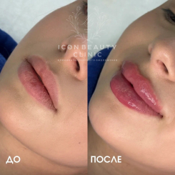 Контурная пластика губ 3